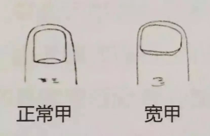 4,凹甲凸甲—气阴两虚特征:凹甲,甲面中央凹下低于四周,甲面上有凹