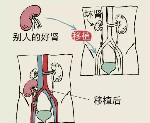 壁虎医生 肾移植术后常见问题解答 一