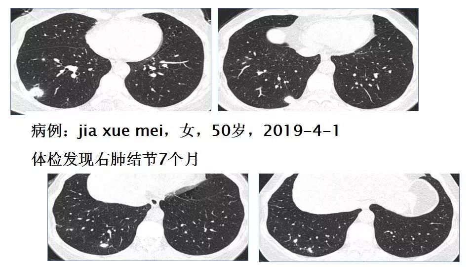 结果:? 病理:肺部结核 提示3: 周围型肺肉芽肿——空洞结节(空腔?)