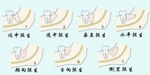 智齿都该拔吗?