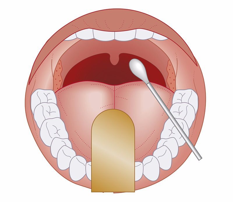 扁桃体炎与扁桃体恶性肿瘤的区别在哪?