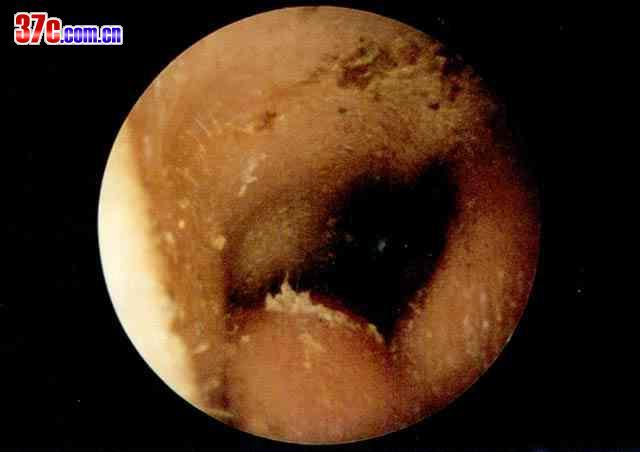 外耳道疖肿预防八法