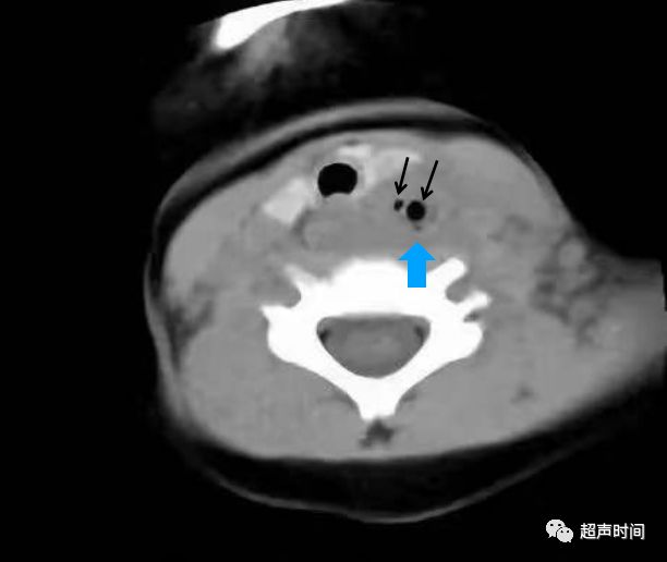 儿童梨状隐窝瘘5个超声病例让你完全读懂