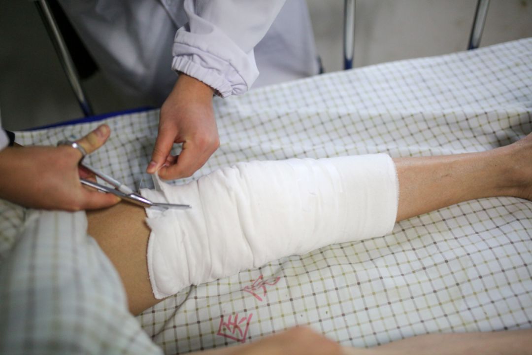 57岁杨师傅一脚不慎,膝盖骨折,神奇 "关节镜",轻松帮他搞定