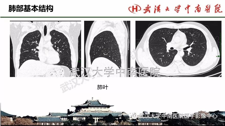 肺部影像解剖及基本概念,基本病变