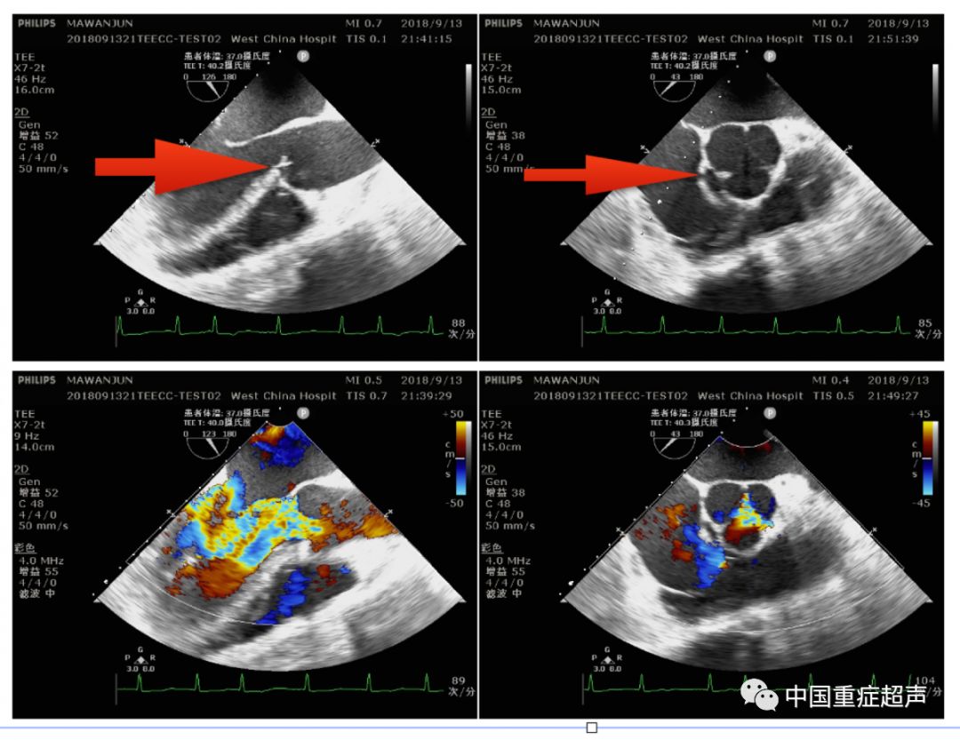 经食管超声中心脏的影像 库存照片. 图片 包括有 的闪烁, 图象, 医疗, 远地点, 心脏病, 颜色, 患者 - 182207524