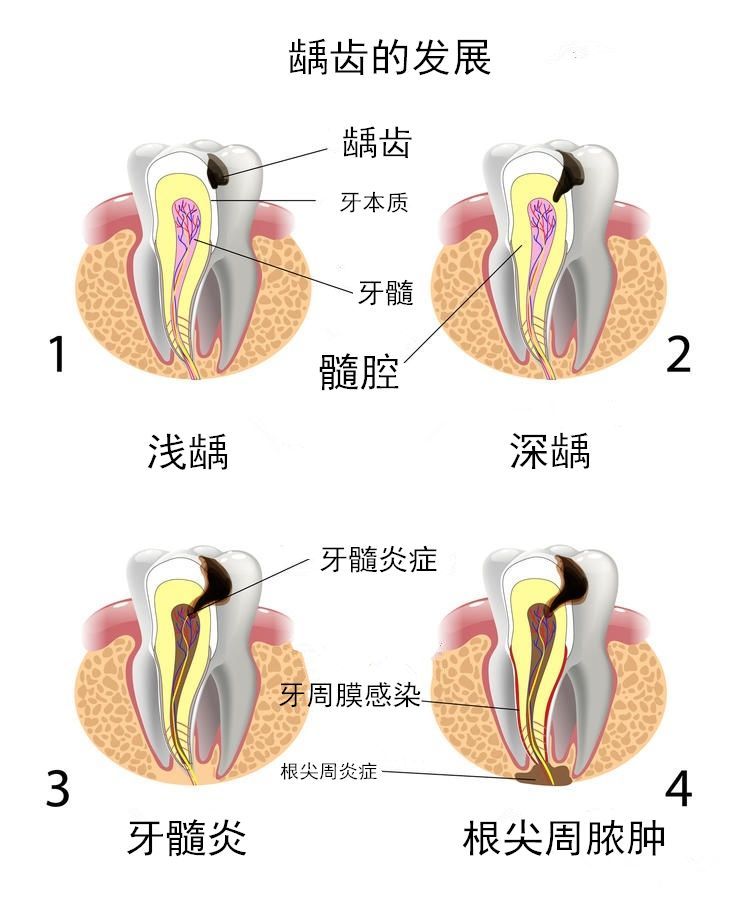 得了龋齿,什么情况可以直接补牙,什么情况又需要做根管治疗?