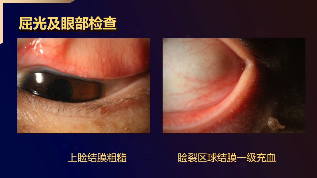 针对有散光的普通软镜配戴者如何通过裂隙灯检查助力产品升级