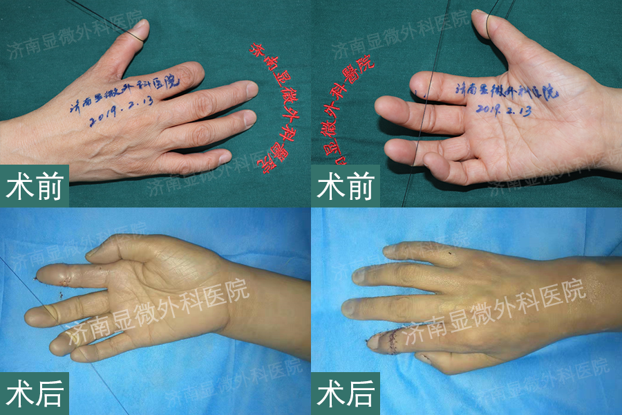 济南显微外科3d全形手指再造案例右手食指再造修复圆华侨42年音乐梦