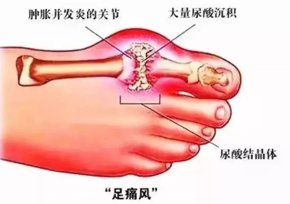 痛风到底有多可怕,这篇文章说透了!