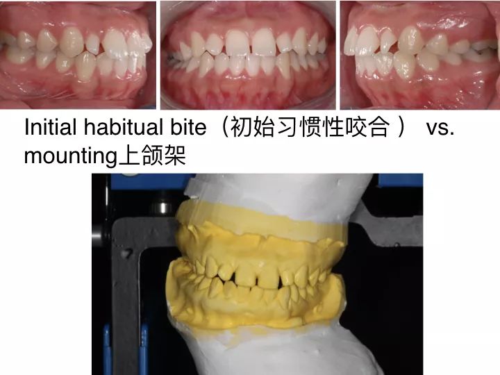 备注:mip(牙尖交错位)下颌避开牙齿干扰点,让最多牙齿咬紧的位置 scp