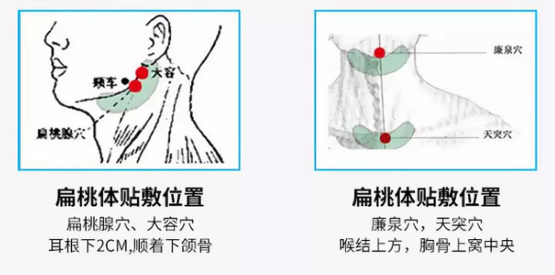 咽炎扁桃体疼睡前用它贴一贴可缓解咽炎