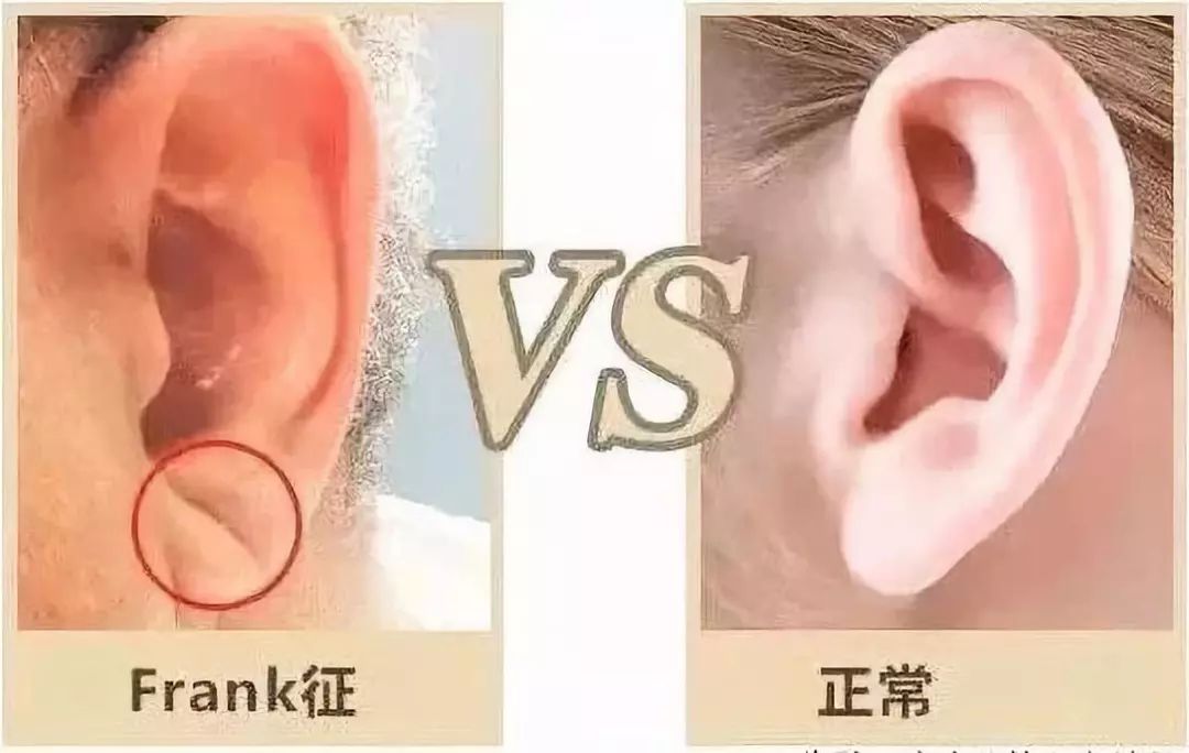 关爱健康 | frank征,亦称耳垂皱褶征