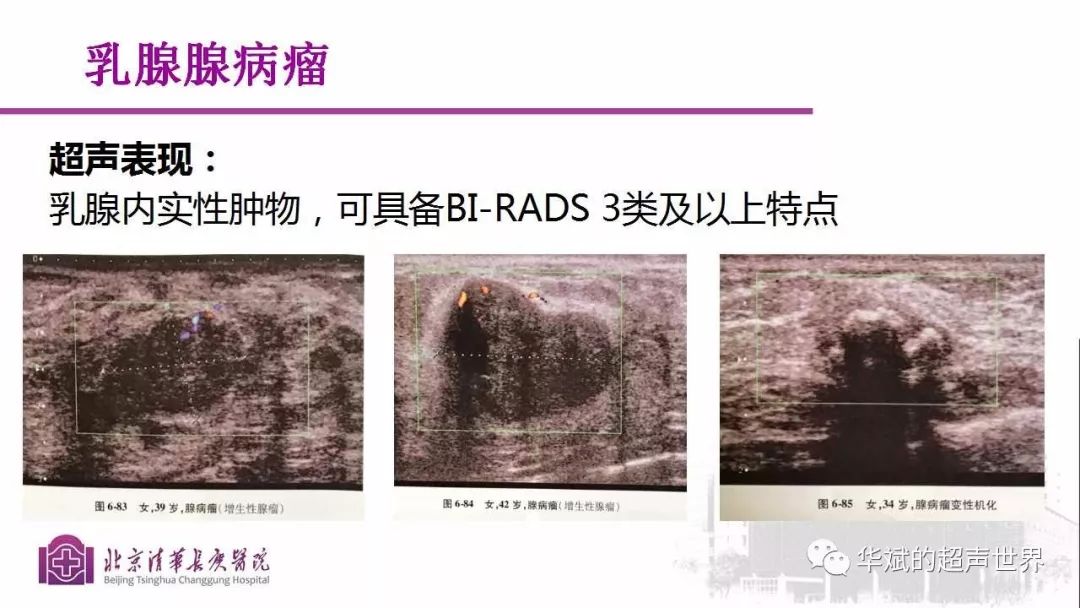 文献与病例学习乳腺腺病瘤和乳腺腺瘤