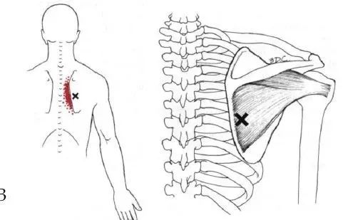 上背痛中背痛激痛点和肌肉疼痛按摩