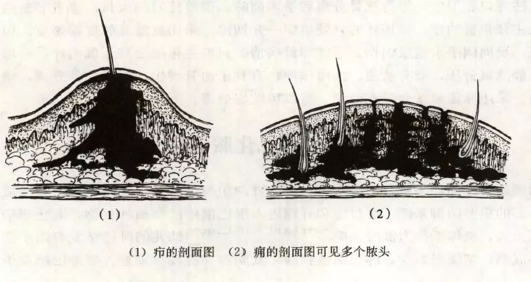 出现脓点,用针头,刀片将脓栓剔除,禁忌挤压;有波动感时,及时切开引流