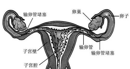 子宫内膜息肉是什么原因导致的 11ccc42b501e415d9a750ae94f4eb640.jpeg