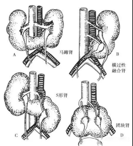 两侧肾相互融合在一起形成一团块状③"s"形肾或乙状肾,一侧肾上极与对