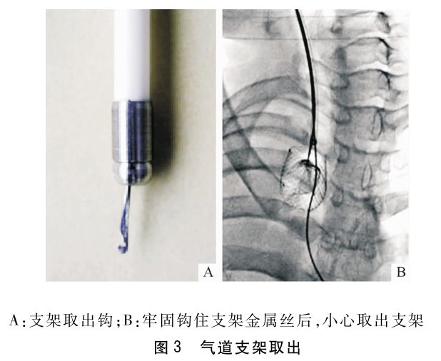 毕永华:透视引导下气道瘘封堵覆膜金属内支架取出术的应用_气管