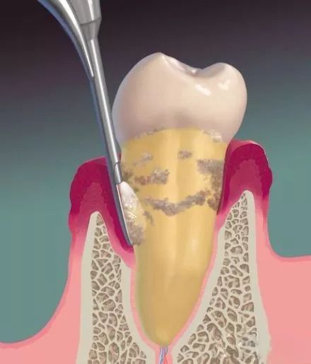 口腔结石是什么意思 febb465a3c9047d2a97aa3c334005e49.jpeg