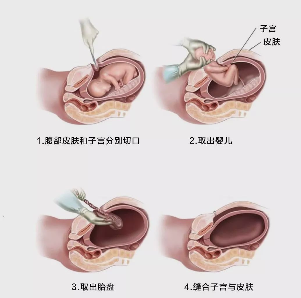 (图:剖宫产示意图)