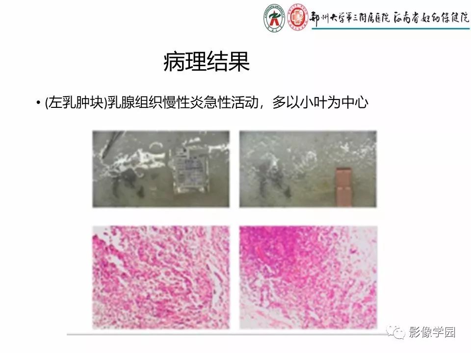非哺乳期乳腺炎性病变与炎性乳癌影像诊断