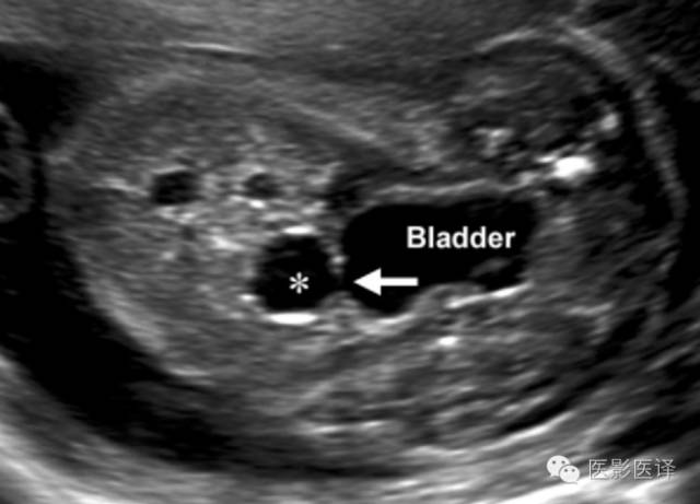 脐尿管囊肿的超声主要表现是脐尿管囊肿与膀胱相通(箭)且从膀胱顶部