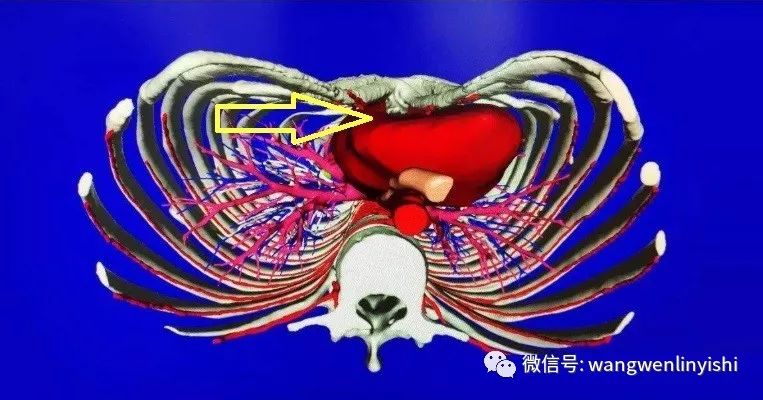 活死人的手术叫什么