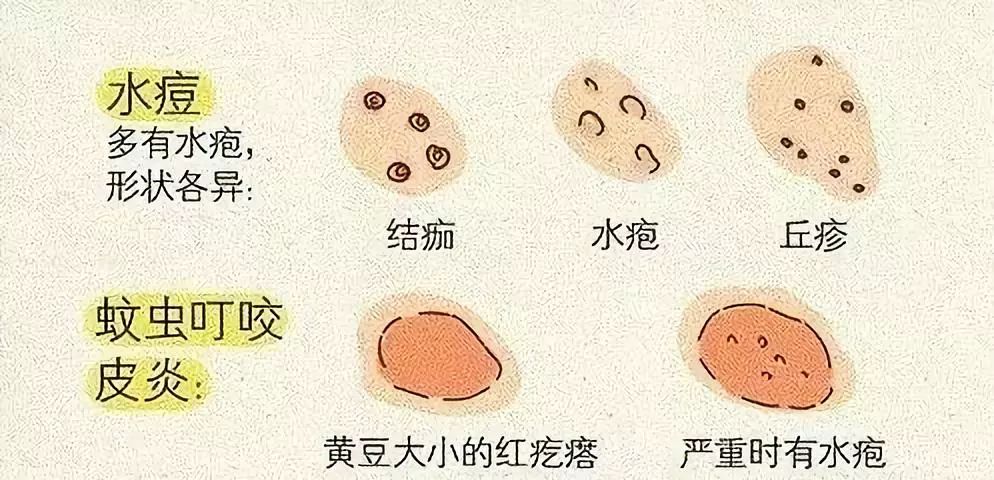 疱疹怎么形成的 5ad0550bd2e944f7929d391471e563d1.jpeg