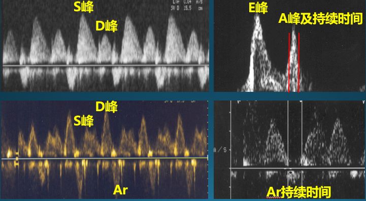 超声心动图十大基本功4.5:肺静脉血流频谱常用指标