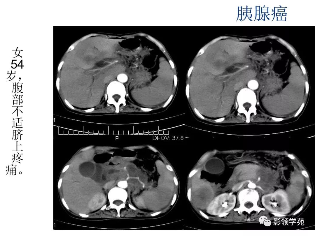 胰腺癌的影像诊断