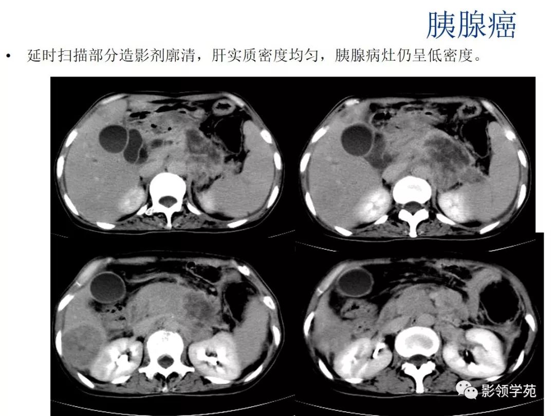 胰腺癌的影像诊断