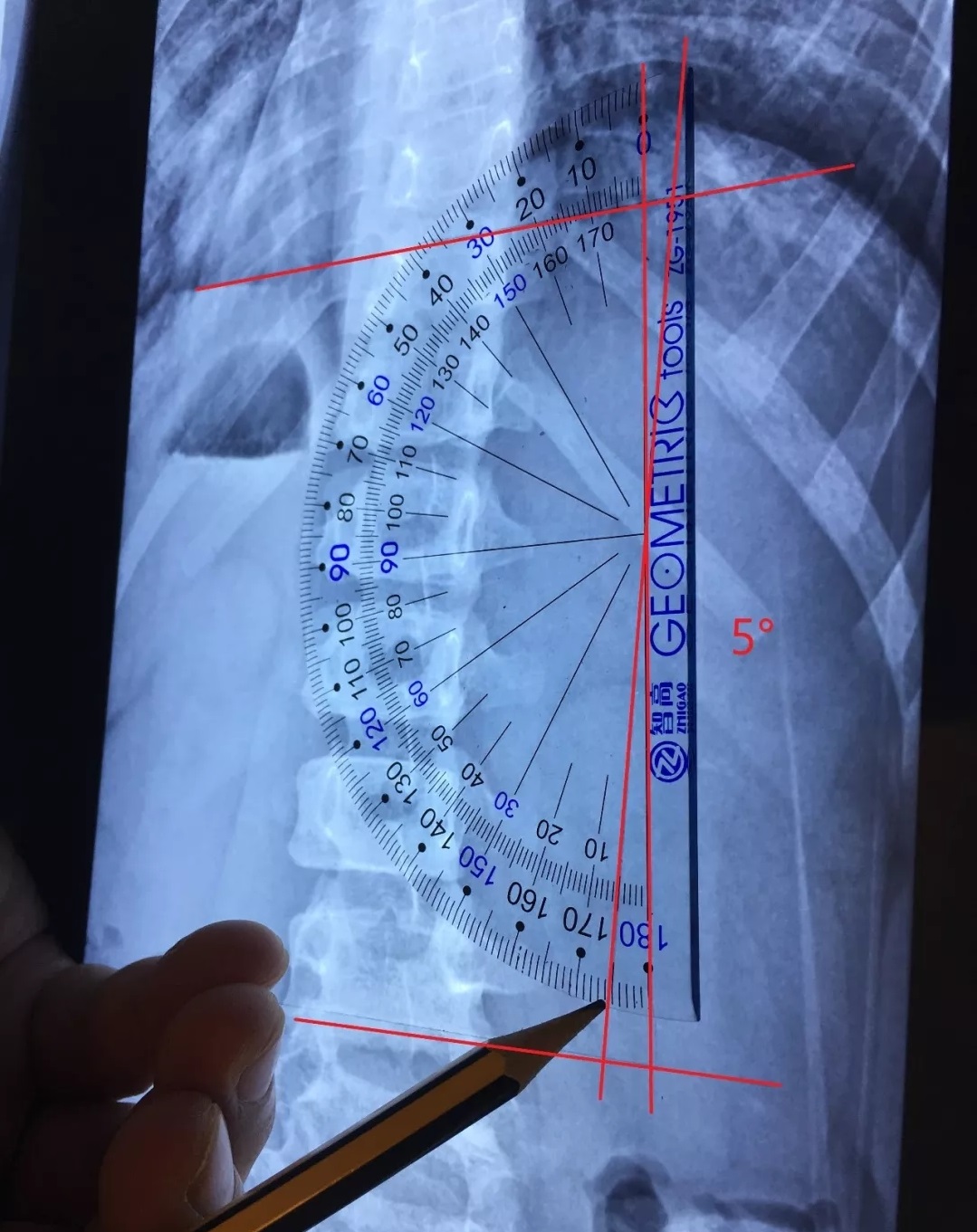 的三维畸形,指脊柱的一个或数个节段在冠状面上偏离中线向侧方弯曲