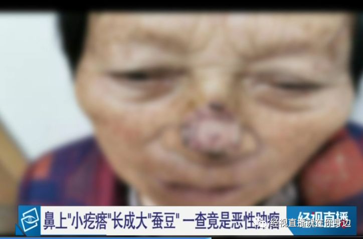 婆婆鼻子冒出肉疙瘩医生一查是癌这类群体高发