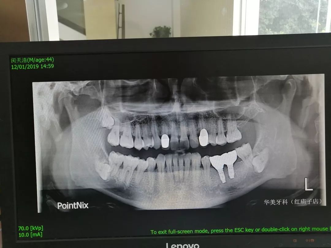 著名笑星闵天浩在华美牙科完成种植牙,他说一辈子不牙疼了!