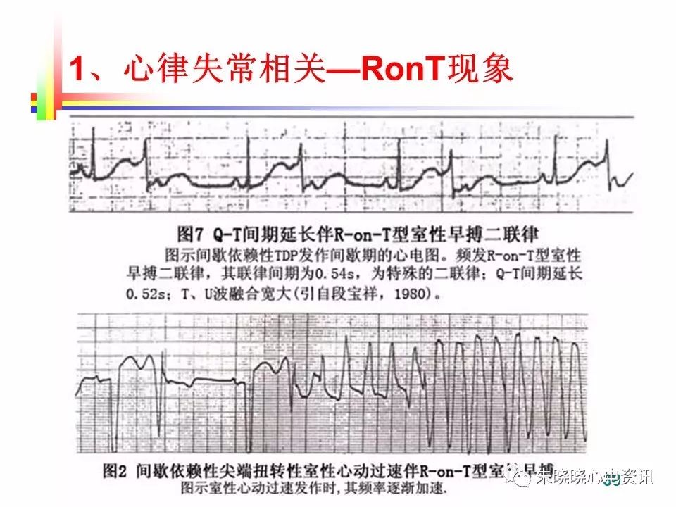 心脏猝死预警心电图(ppt)