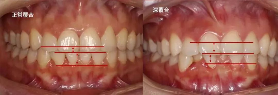 深覆盖vs深覆合看完这篇就都明白了