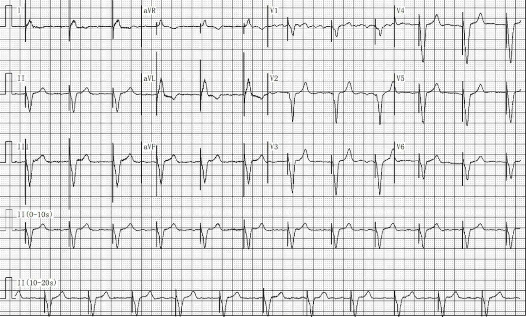 只会看常规心电图远不够这4种起搏心电图你会看吗上海心律失常论坛