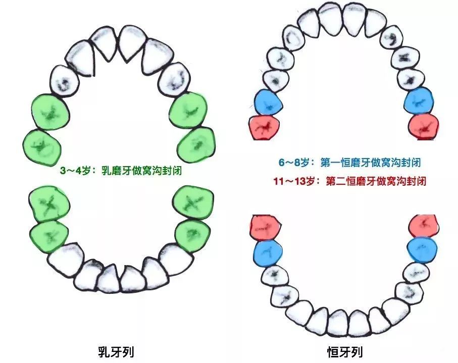 一般来讲,孩子做窝沟封闭大概需要分三次完成,总共8颗乳磨牙,8颗乳