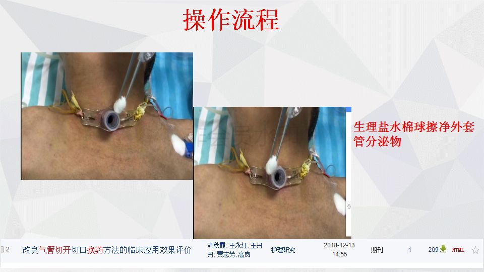 ppt气管切开换药内附视频