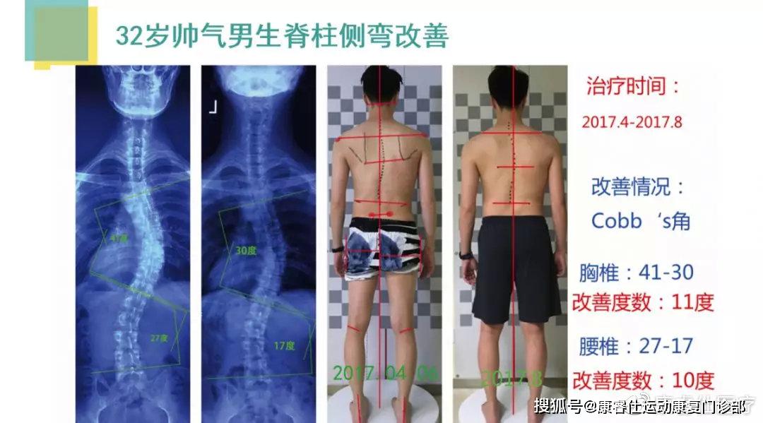 康睿仕医疗-脊柱侧弯保守疗法效果 一,全球百万施罗特矫正成功案例