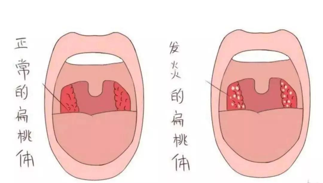 【耳鼻喉诊室】扁桃体反复发炎真的只能手术切除吗?