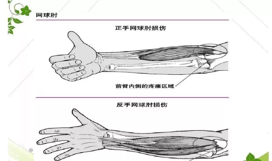 导致肱骨外上髁炎的原因以及治疗方法