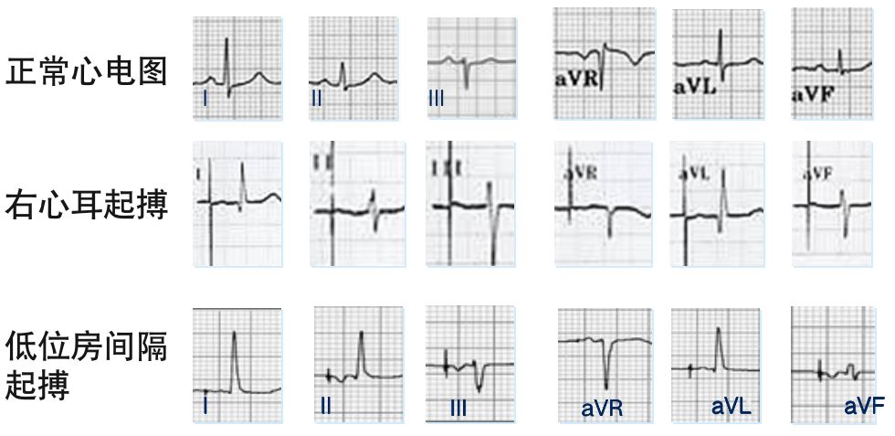 心房:波形与正常 p 波差别不大,不同导联上略有不同,低位房间隔起搏时