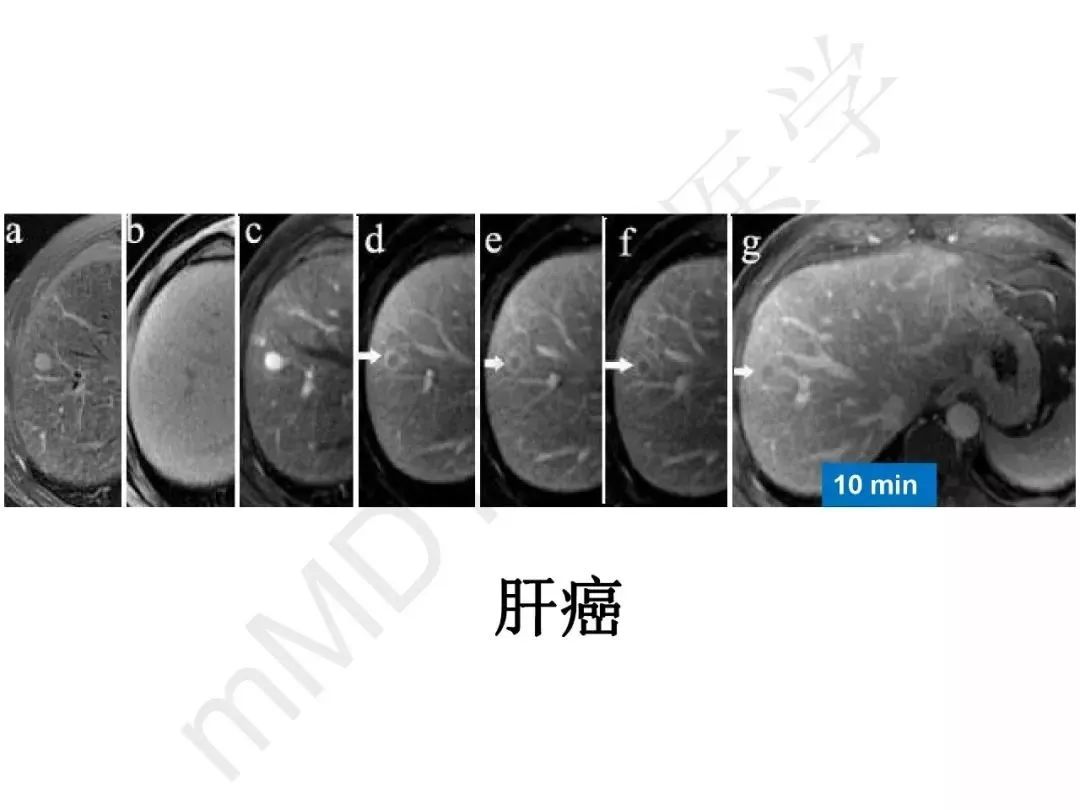 纤维组织在肝脏炎性病变mr诊断中的价值