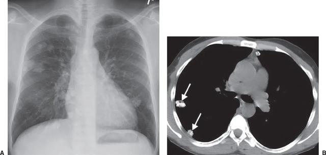 肺部钙化灶是什么意思