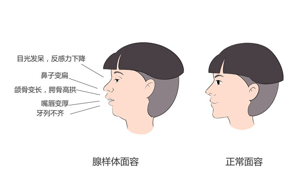 如何判断是腺样体面容