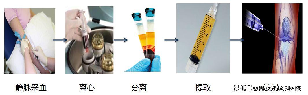 华澳疼痛康复中心prp治疗技术为组织修复"加速器"