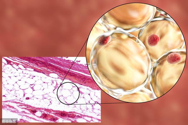 脂肪瘤人口的百分几_皮下脂肪瘤图片(2)