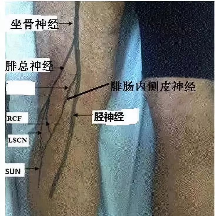 坐骨神经和肩胛上神经体表定位